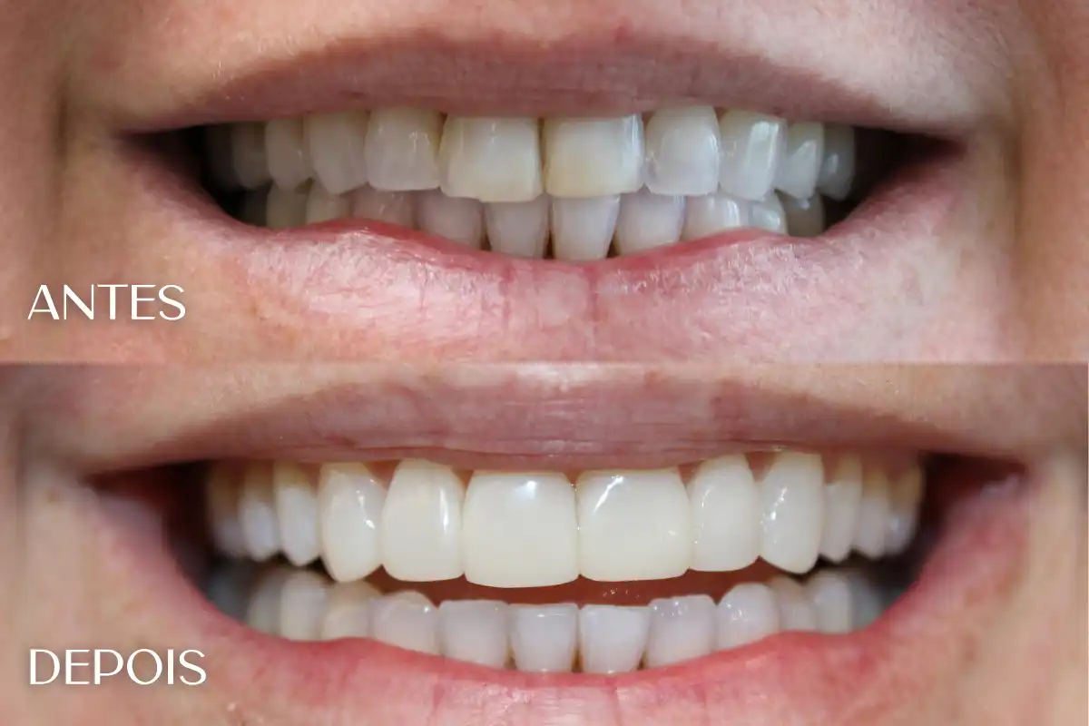 Antes e depois de facetas em resina em Salvador — caso 1, Dra. Leidianne Abreu