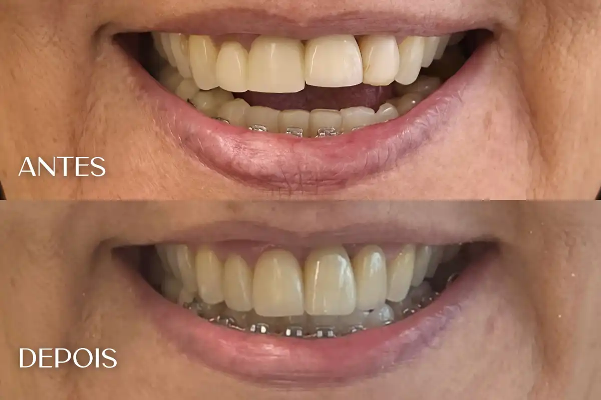 Antes e depois de facetas em resina em Salvador — caso 2, Dra. Leidianne Abreu
